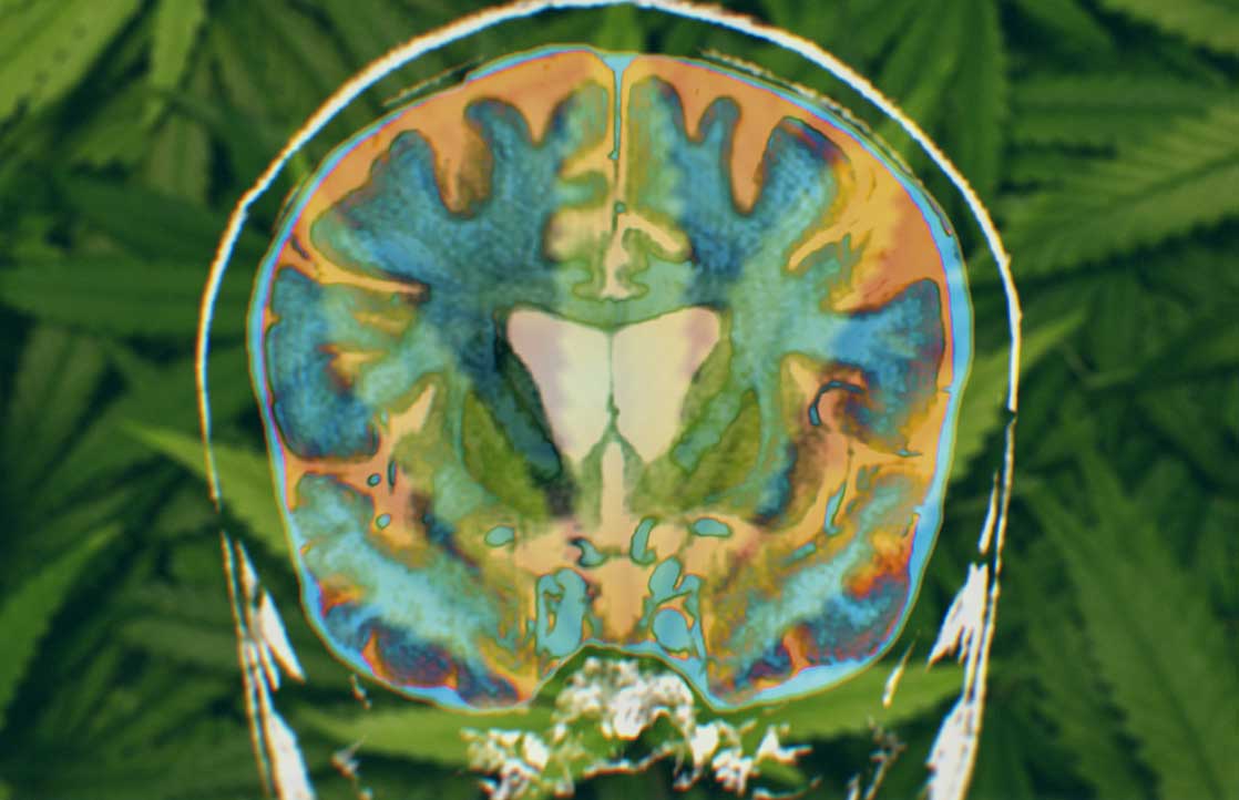 How Cannabis Treats Huntington’s Disease