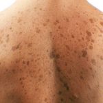 Skin-cancer-patients-may-find-relief-with-cannabis