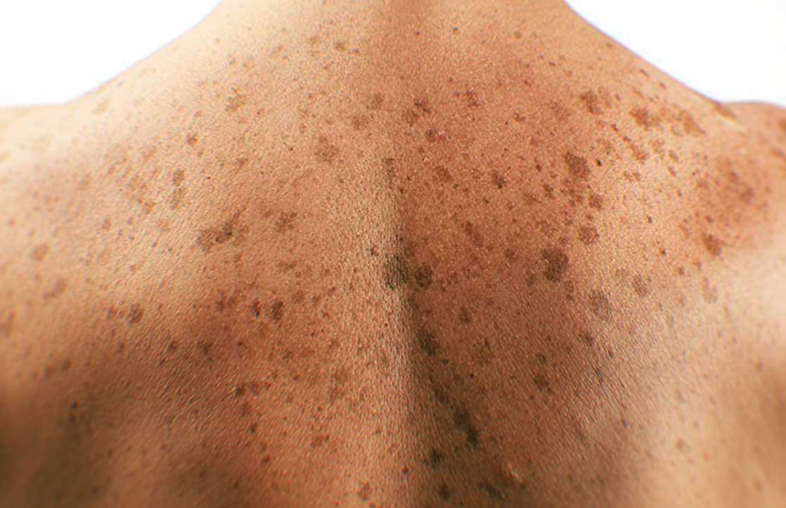 Skin Cancer Patients May Find Relief With Cannabis