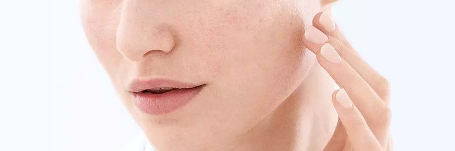 cannabis for acne