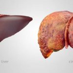 Healthy-Liver-vs-Cirrosis